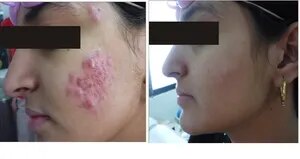 Acne image 1