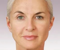 Face Lifting Treatments image 1