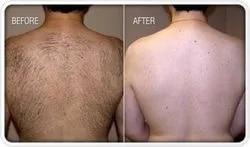 Laser Hair Removal Back Treatments image 1