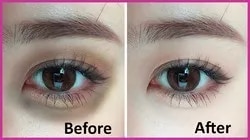 Anti Dark Circle Treatment image 1