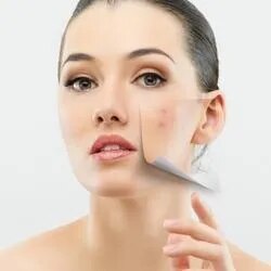 Anti Acne Treatment image 1
