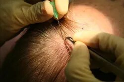 Hair Transplantation image 1