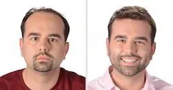 Hair Replacement image 1