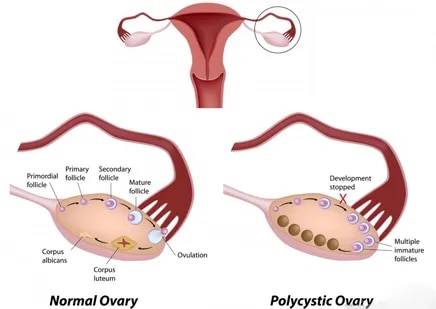 PCOD Treatment image 1