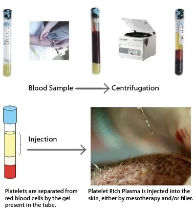 PRP Treatment image 1