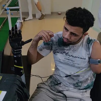 Upper Limbs Prosthesis image 1
