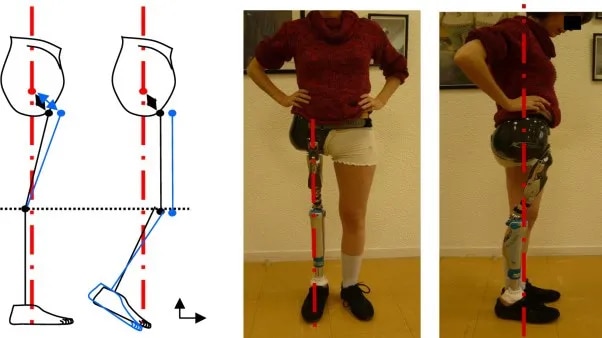 Knee Disarticulation Prosthetic image 1