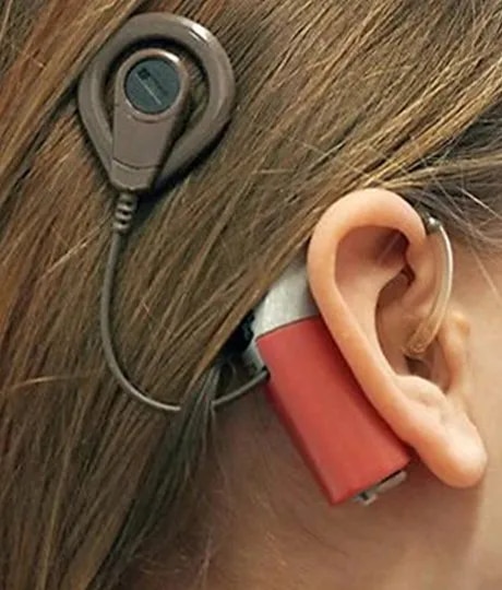 Cochlear Implants image 1