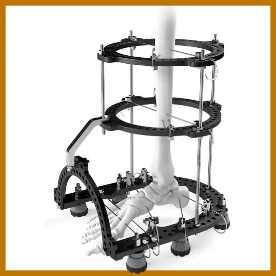 External Fixator System image 1