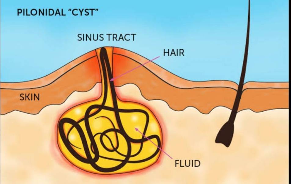 Laser Pilonidal Sinus Surgery