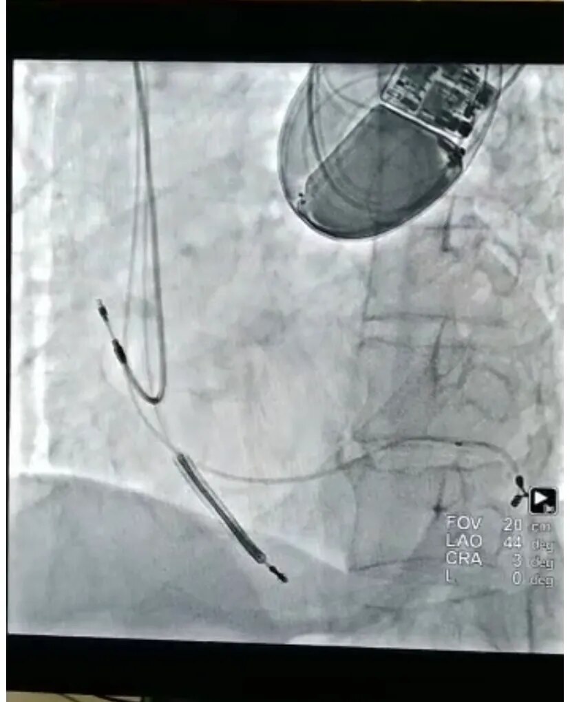 Cardiac Resynchronisation Therapy (CRTD) image 1