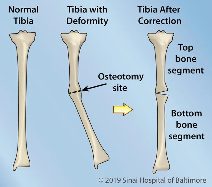 Deformity correction. image 1