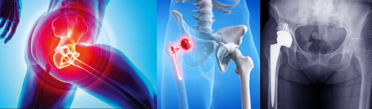 Knee & Hip Replacement image 1