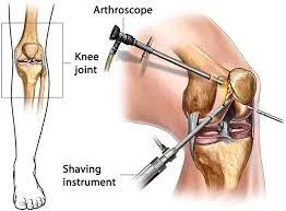 Arthroscopy image 2
