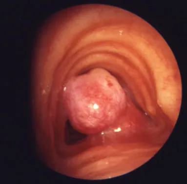 tracheal sleeve resection with end to end anastomosis for tracheal tumour image 1