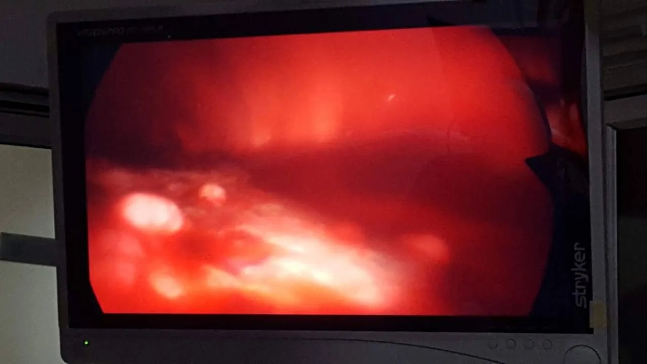 Thorcoscopic Lung Nodule Biopsy image 1