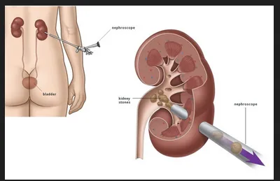 PCNL image 1