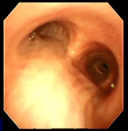 Bronchoscopy image 1