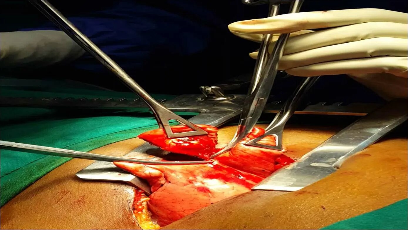 Wedge Resection image 1