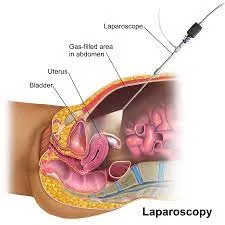 Laparoscopy image 1