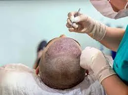 Hair Transplant image 1