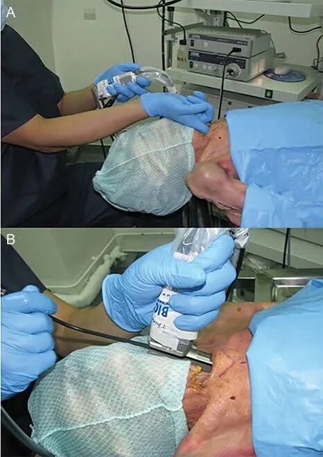 Mediastinoscopy image 1
