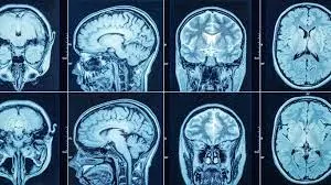 CT Scan image 2