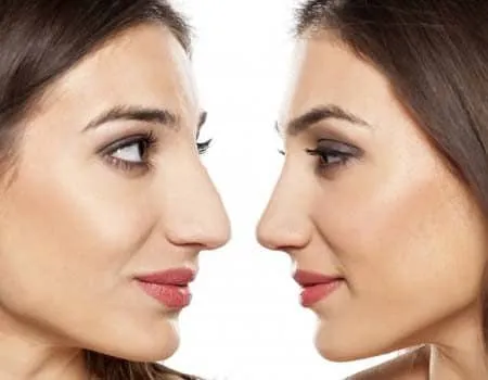 Rhinoplasty  image 1