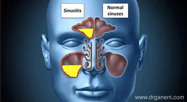 Endoscopic Sinus surgery image 1