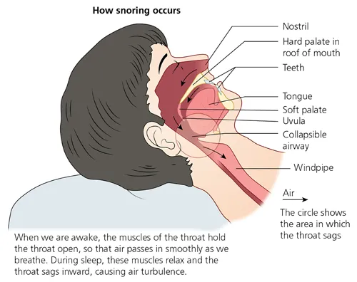 Snoring image 1