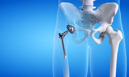 Hip Replacement image 1