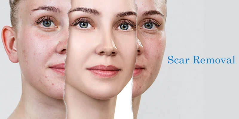 BURNS, SURGICAL SCARS, ACCIDENTAL SCAR REMOVAL image 1