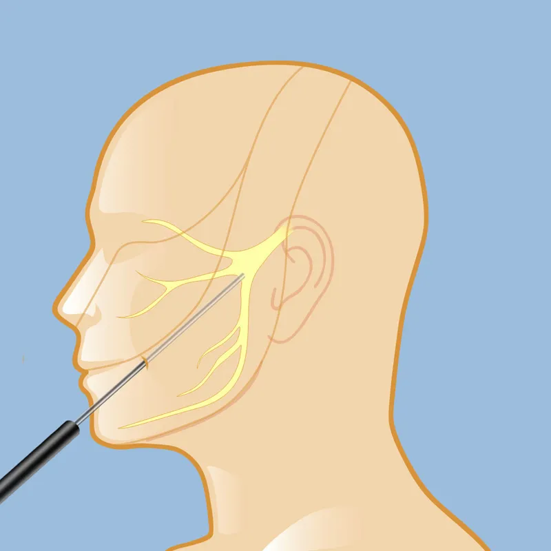 Surgery for Trigeminal Neuralgia image 1