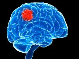 Brain Tumors image 1