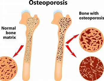 Osteoporosis image 1