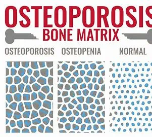 Osteoporosis image 3
