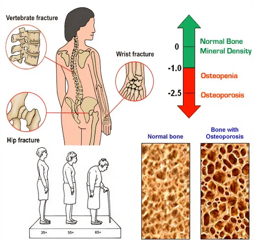 Osteoporosis image 2