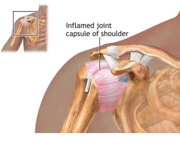 Arthroscopy and Sports injury(ACL/MENISCUS/ROTATOR CUFF INJURY) image 3