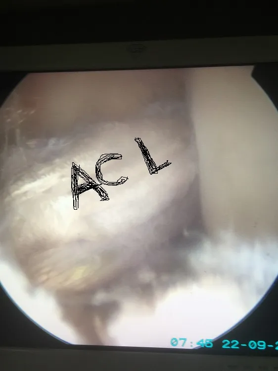 Arthroscopy and Sports injury(ACL/MENISCUS/ROTATOR CUFF INJURY) image 6