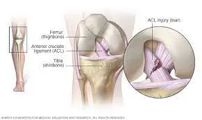 Arthroscopy and Sports injury(ACL/MENISCUS/ROTATOR CUFF INJURY) image 2