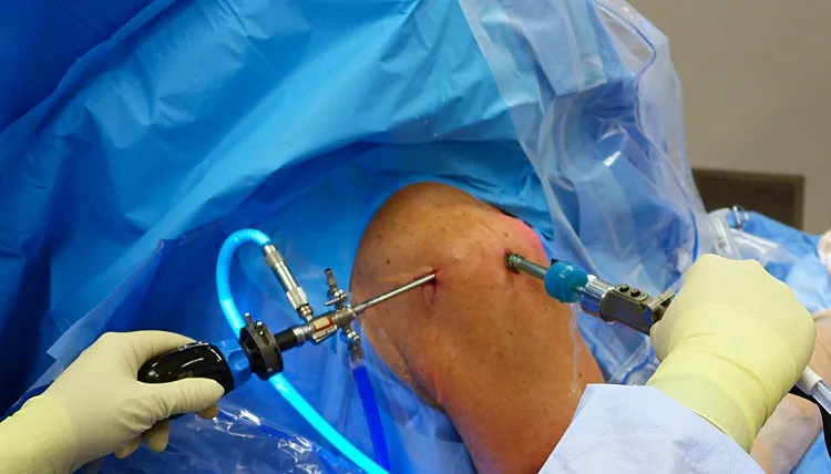 Arthroscopy and Sports injury(ACL/MENISCUS/ROTATOR CUFF INJURY) image 4