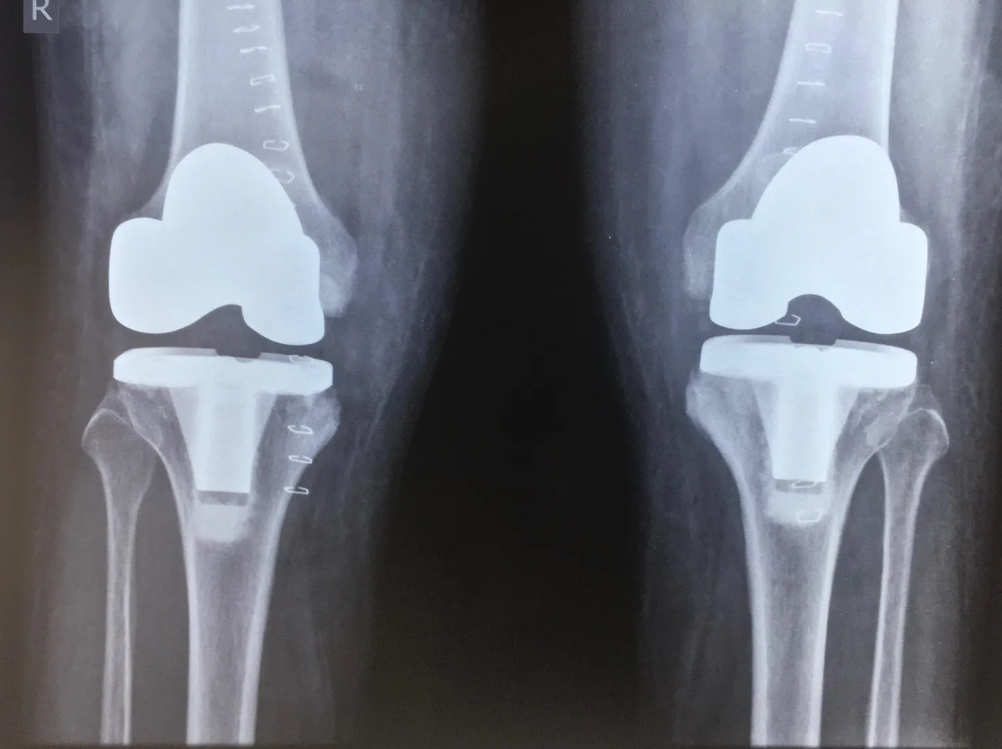 Total Knee Replacement image 1
