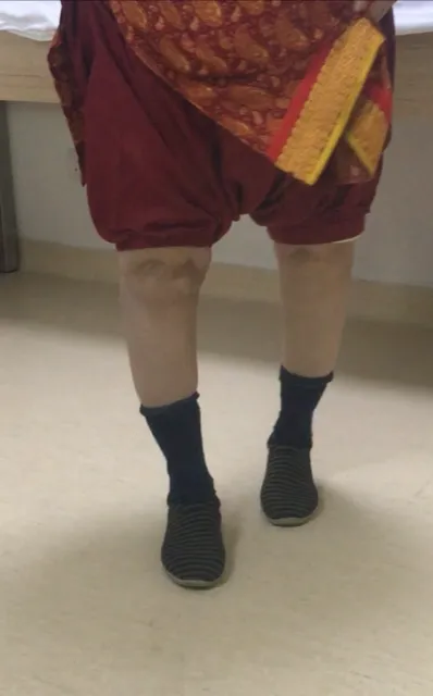 Total Knee Replacement image 7