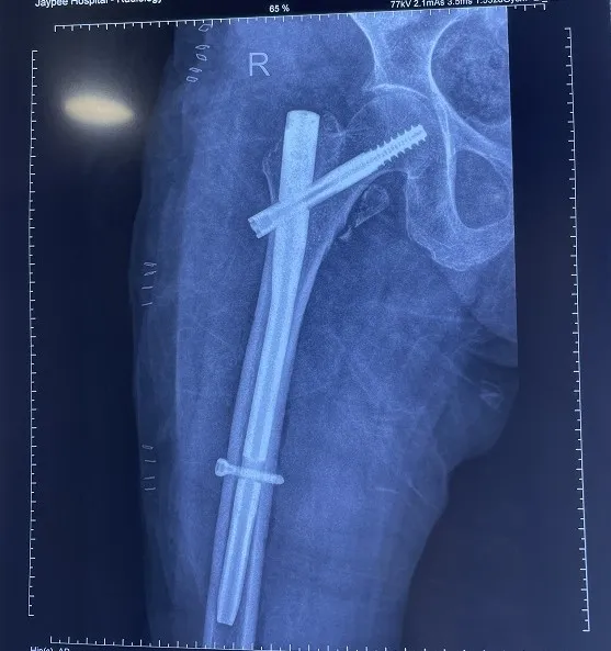FRACTURE AND COMPLEX TRAUMA image 1