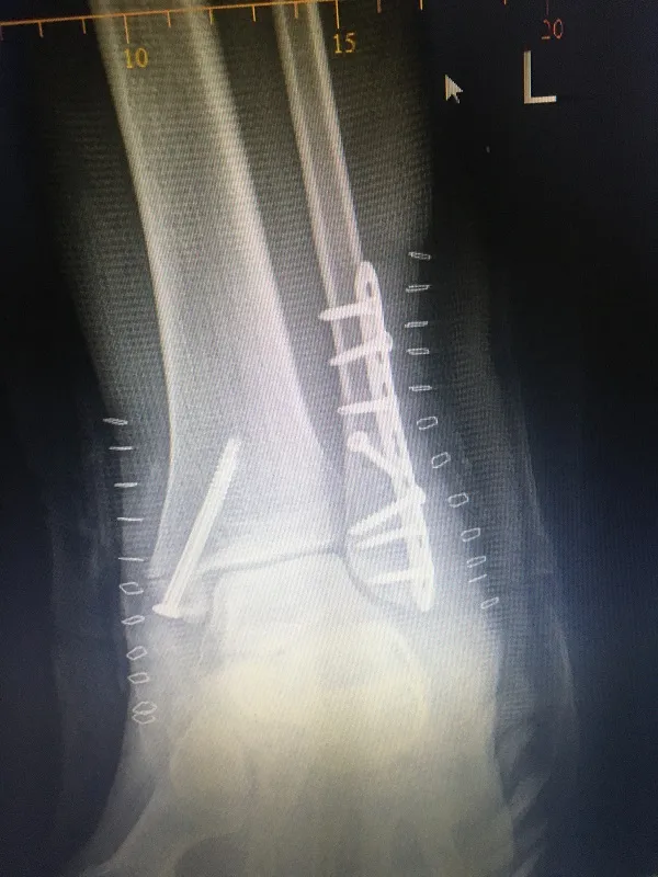 FRACTURE AND COMPLEX TRAUMA image 3