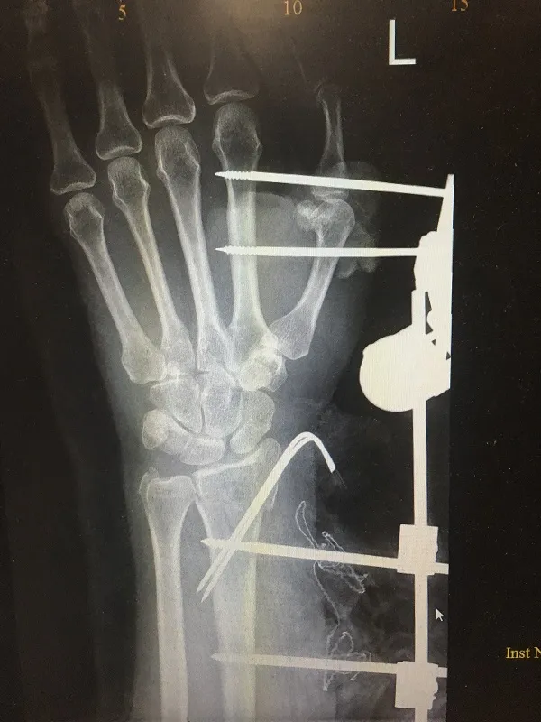 FRACTURE AND COMPLEX TRAUMA image 4
