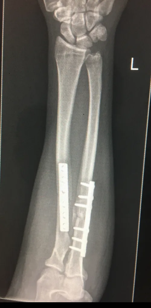 FRACTURE AND COMPLEX TRAUMA image 5