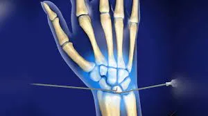 Hand/Wrist Arthroscopy image 1