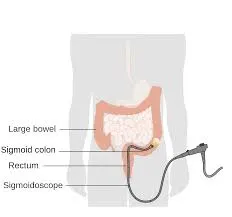 SIGMOIDOSCOPY image 1