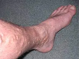 VARICOSE VEINS image 1